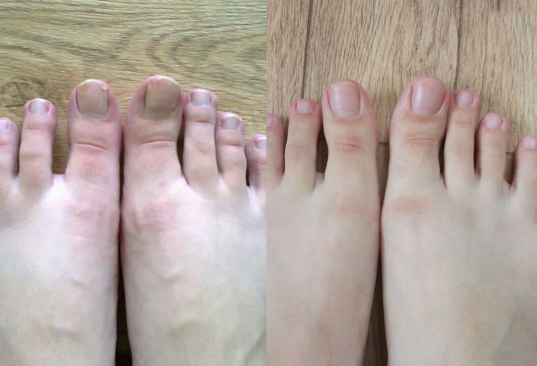 Vor und nach der Behandlung die Pilz -Promisil -Creme