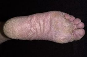 Anzeichen und Symptome von Pilz an den Beinen