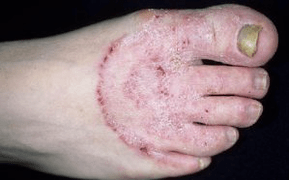 Die Gründe für das Aussehen des Pilzes an den Beinen