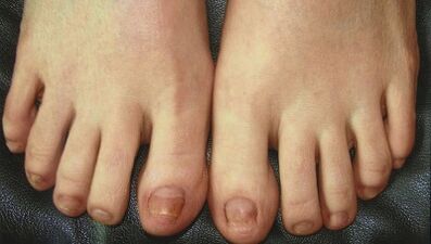 Entwicklungsphasen von Nagelpilz