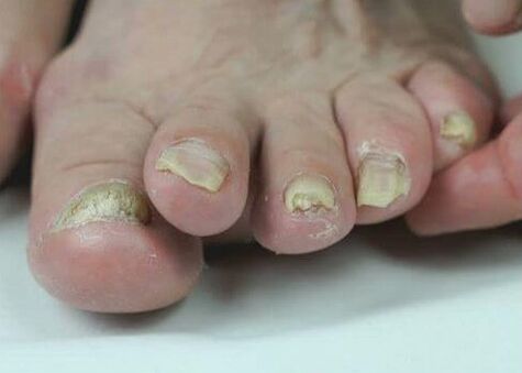 Behandlung von Nagelpilz mit Medikamenten