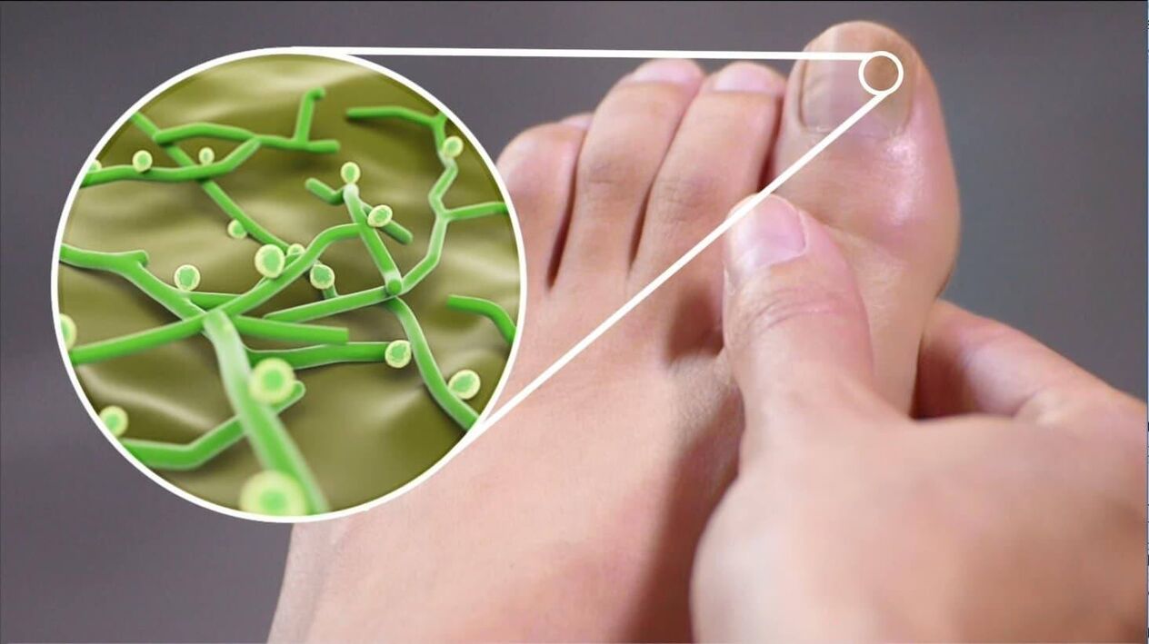 Erreger des Zehennagelpilzes