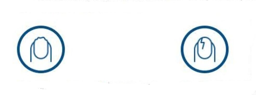 Verformung der Nägel aufgrund einer Pilzinfektion